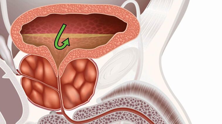 semne de prostatită cum să trateze operatie laparoscopica de prostata