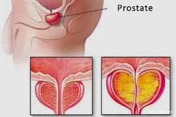 prostată
