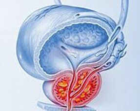 Inflamarea prostatei cu prostatită