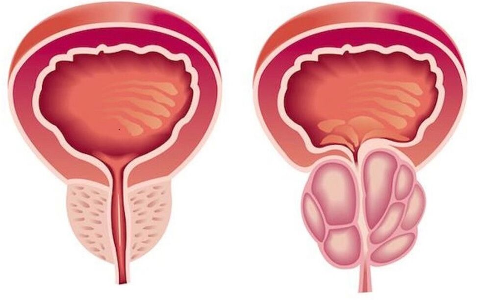 prostată sănătoasă și inflamată cu prostatita