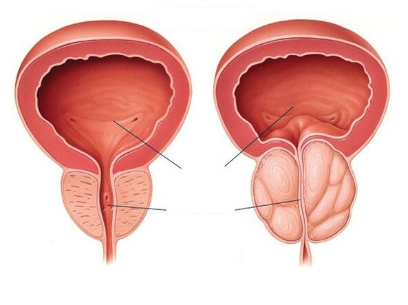 recuperat din prostatită regim alimentar dupa operatia de adenom de prostata